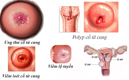 bệnh polyp cổ tử cung